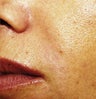 Sculptra