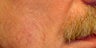 Sculptra