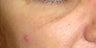 Sculptra