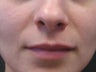 Sculptra injections