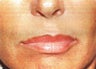 Sculptra