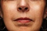 Sculptra