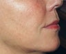 Sculptra