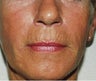 Sculptra Treatment