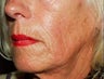 Sculptra Treatment