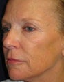 Sculptra Injections