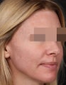 Sculptra and Restylane