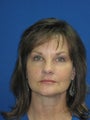 Sculptra to malar and chin, juvederm to lips, botox to glabella