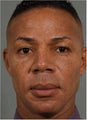 45 Year old Aftrican American male treated for facial lipo atrophy (loss facial volume)