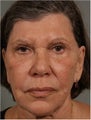 77 Year Old Female Treated for Facial Volume Loss and Lax Skin