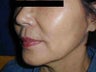 Sculptra