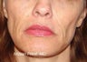 Sculptra