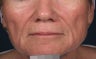 Fillers - Sculptra