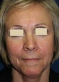 Sculptra Liquid Lift