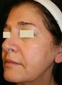 Sculptra Liquid Lift