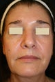 Sculptra