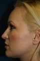 Sculptra
