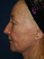Sculptra Liquid Lift
