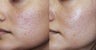 Acne scar