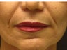 Sculptra