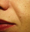 Sculptra