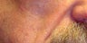 Sculptra