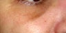 Sculptra
