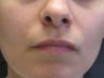 Sculptra injections