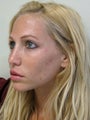 Sculptra