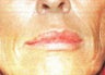 Sculptra