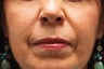 Sculptra