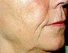 Sculptra