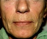 Sculptra Treatment