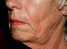 Sculptra Treatment