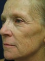 Sculptra Injections