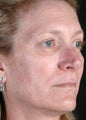 Sculptra Aesthetic