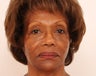 Sculptra Injection: 3 Vials to Midface and Jowls