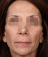Sculptra