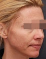 Sculptra and Restylane