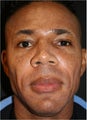 45 Year old Aftrican American male treated for facial lipo atrophy (loss facial volume)