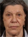 77 Year Old Female Treated for Facial Volume Loss and Lax Skin