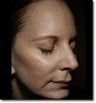 Sculptra