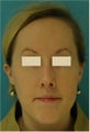 Rhinoplasty, Septoplasty