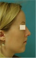 Rhinoplasty, Septoplasty