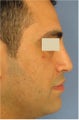 Rhinoplasty, Septoplasty