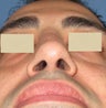 Rhinoplasty, Septoplasty