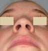 Rhinoplasty and Septoplasty