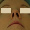 Rhinoplasty, Septoplasty