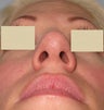 Rhinoplasty, Septoplasty