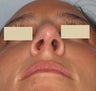 Rhinoplasty, Broken Nose